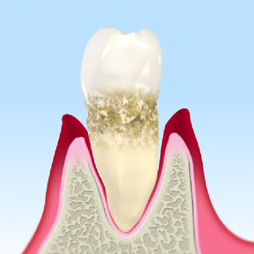 中等度の歯周病